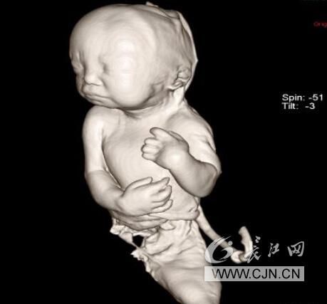“人鱼宝宝”惊现武汉 市儿童医院7年发现12例