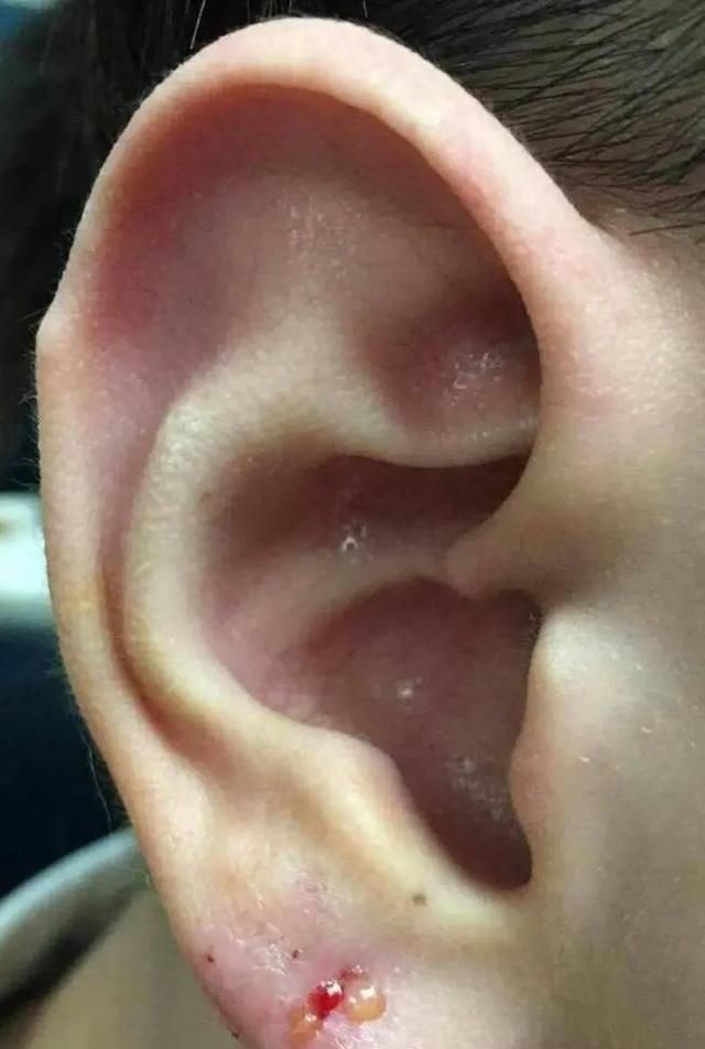 小耳洞大风险，打耳洞需要注意什么？