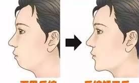 有双下巴怎么才能减掉双下巴,怎样才能减掉脸上的双下巴肉图13