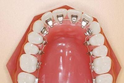 什么样的牙套好(牙套戴什么样的好)图4